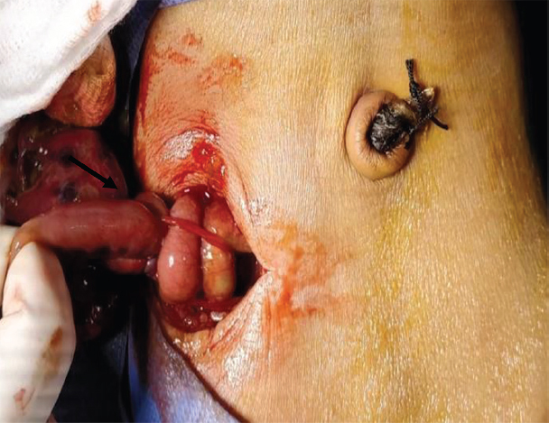 Volvulus of jejunum.